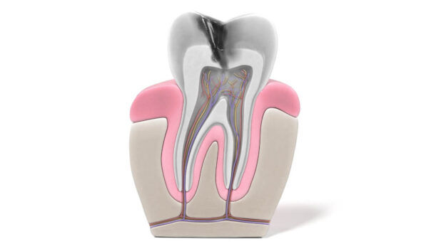 Endodoncia Luxodent Endodoncia Luxodent