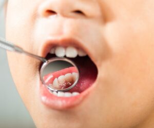 ¿Cómo Prevenir las Caries en los Dientes de Leche?
