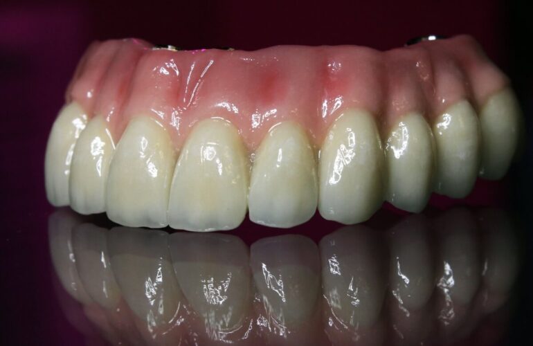 Prótesis Híbrida: Rehabilitación Oral Integral