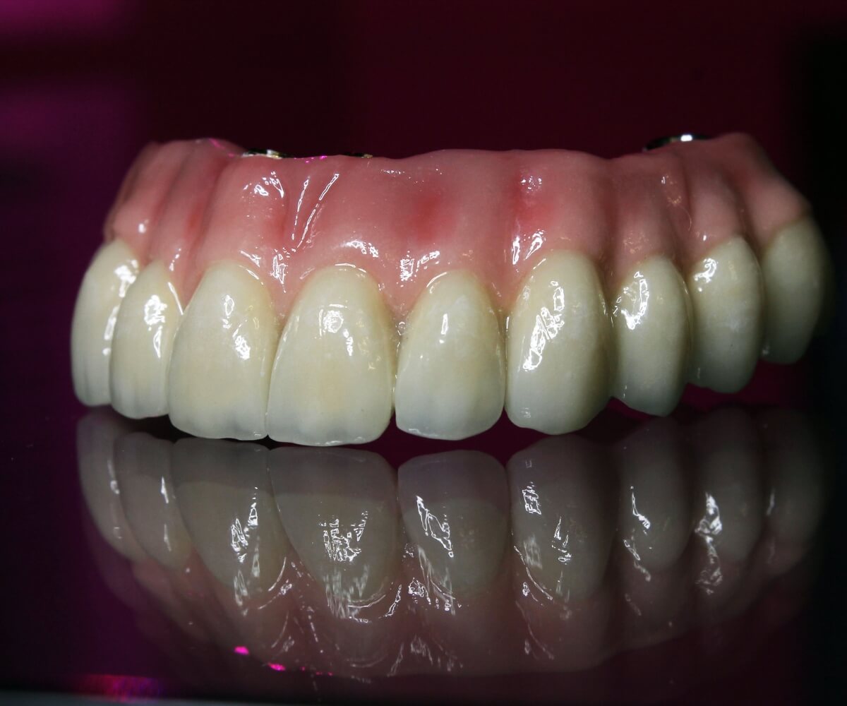 Prótesis Híbrida: Rehabilitación Oral Integral