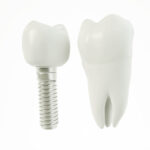Implantes Dentales de Última Generación