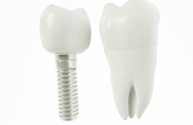 Implantes Dentales de Última Generación
