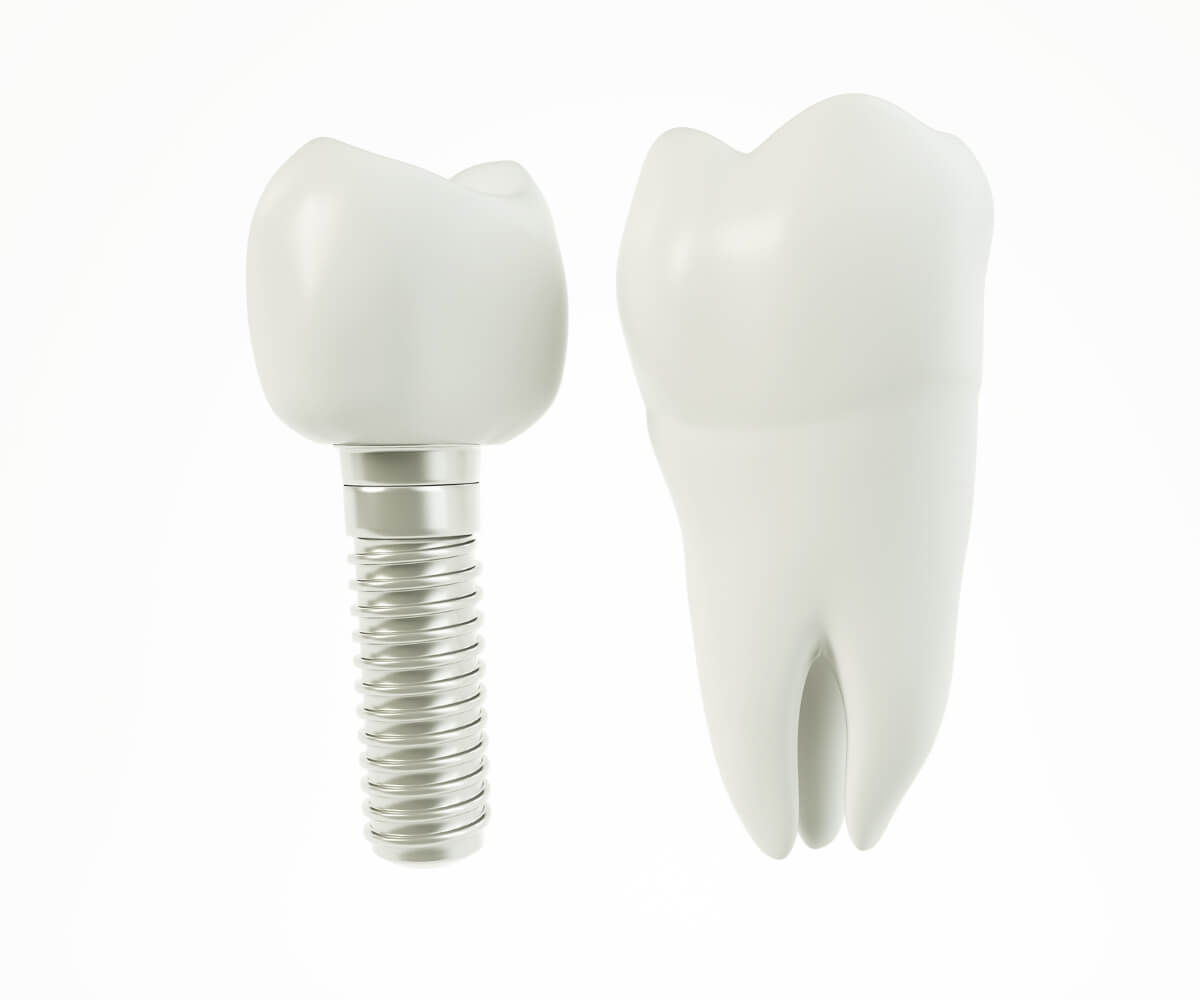 Implantes Dentales de Última Generación